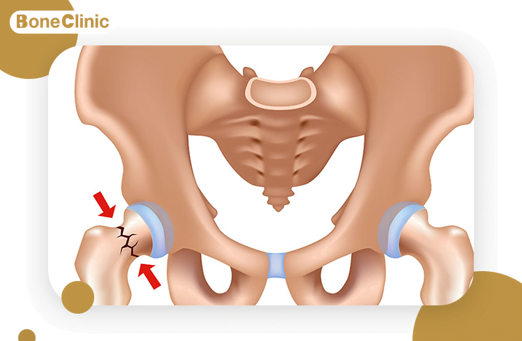 تكلفة عملية تغيير مفصل الفخذ 