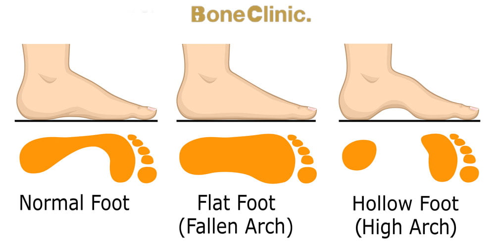 ما هي درجات الفلات فوت؟