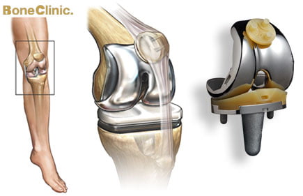تكلفة عملية غضروف الركبة بالمنظار في مصر تكلفة عملية غضروف الركبة بالمنظار في مصر