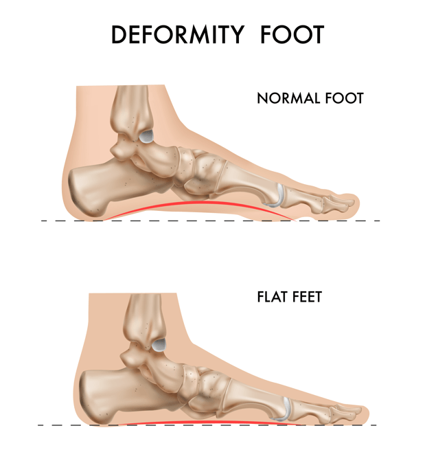 تكلفة عملية الفلات فوت