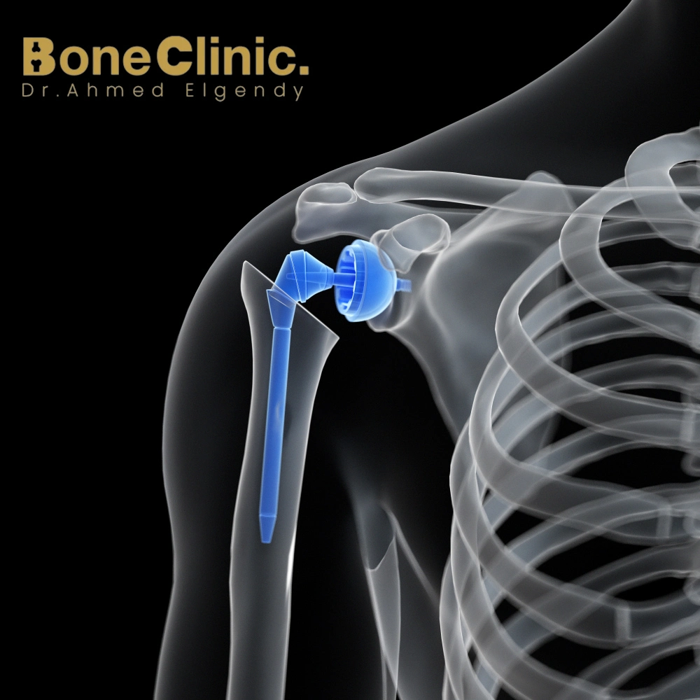 اعراض التهاب مفصل الكتف