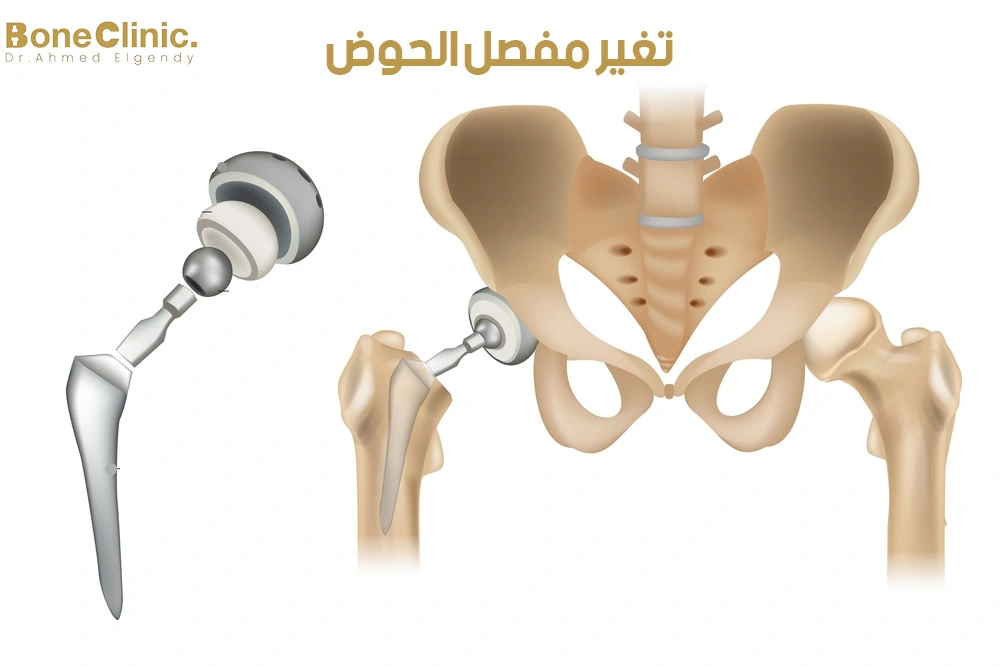 إجراءات عملية تغيير مفصل الحوض