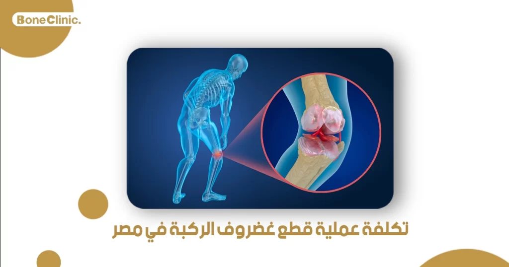 تكلفة عملية قطع غضروف الركبة في مصر