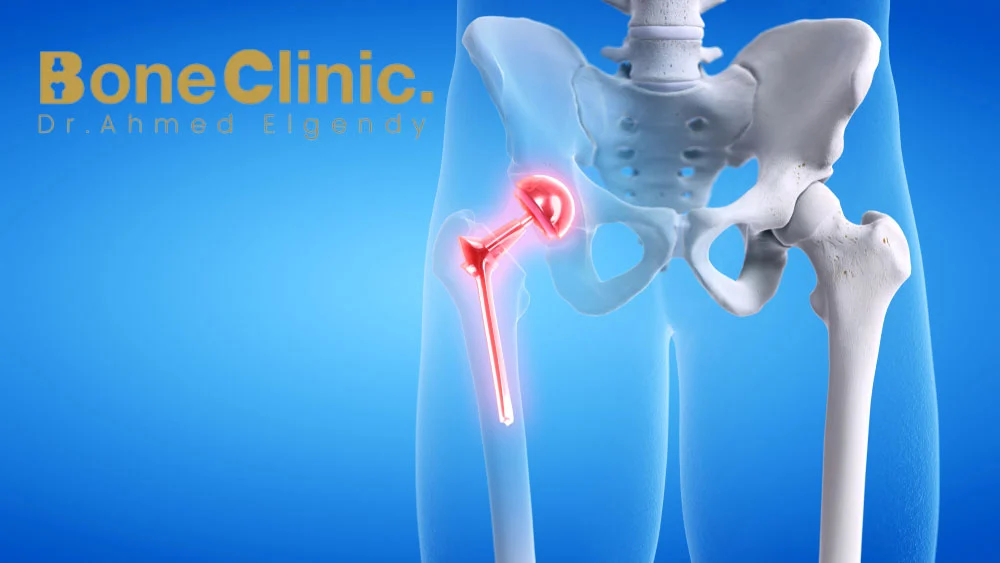 نسبة نجاح عملية تثقيب مفصل الفخذ