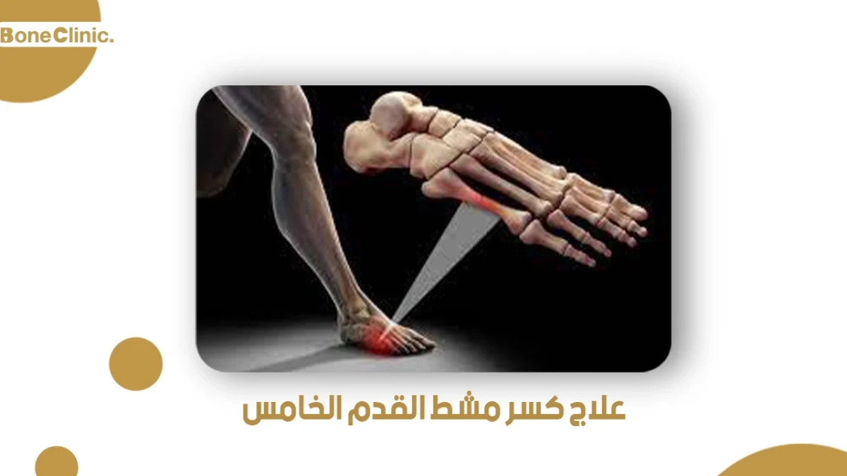 علاج كسر مشط القدم الخامس