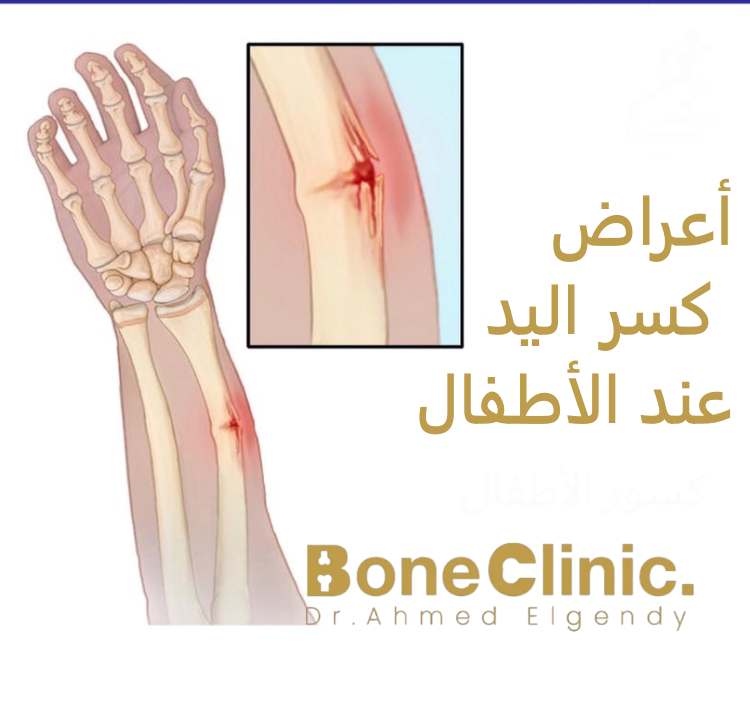 أعراض كسر اليد عند الأطفال