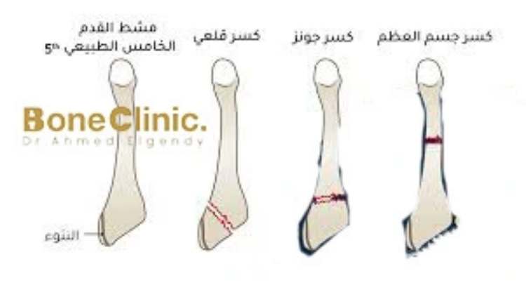 أعراض كسر مشط القدم الخامس