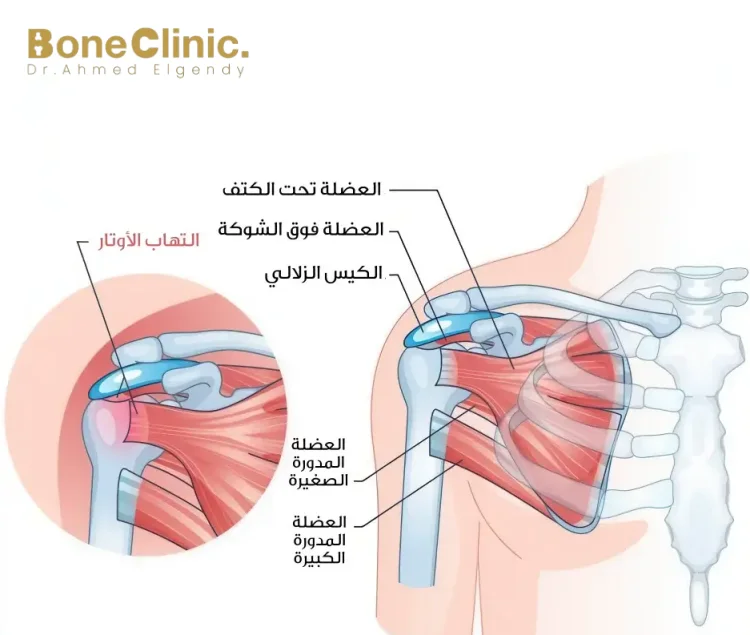 الوقاية من التهاب أوتار الكتف