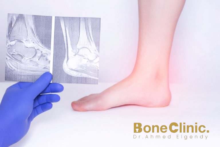 كم يستغرق علاج وتر اكيلس