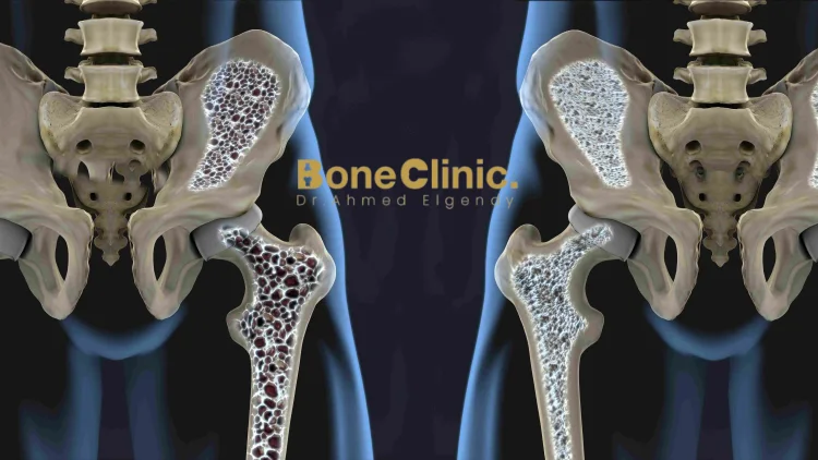 ما هو الفرق بين التهاب المفاصل وهشاشة العظام؟