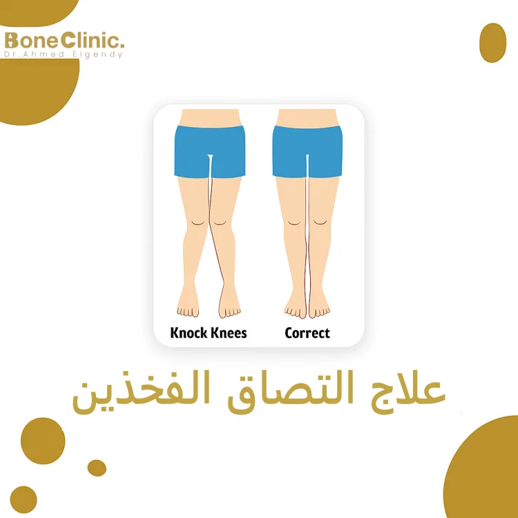 علاج التصاق الفخذين​
