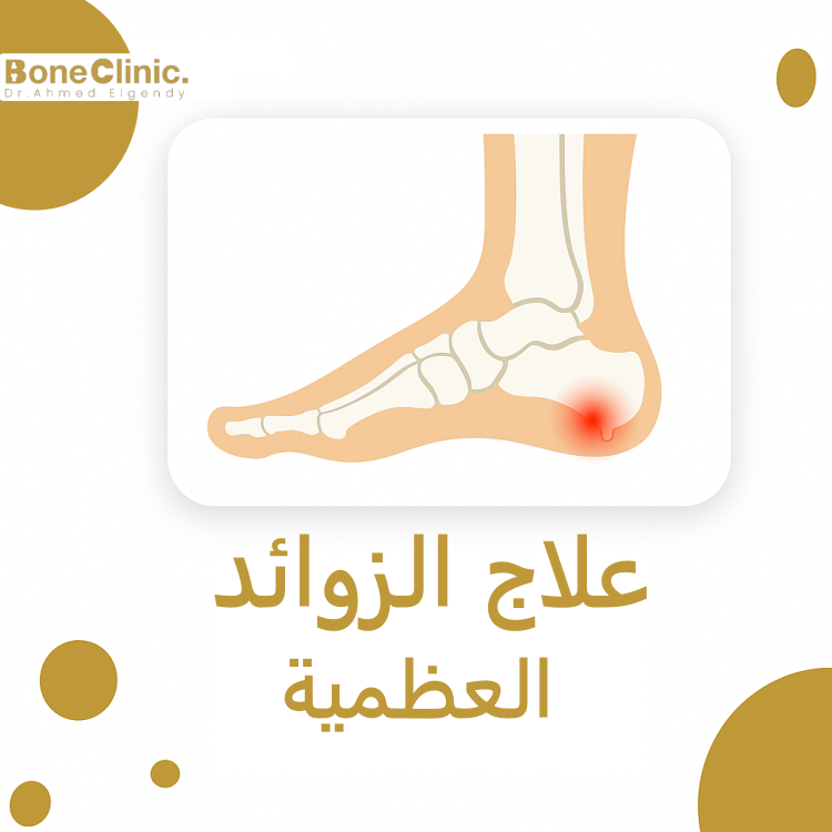 علاج الزوائد العظمية