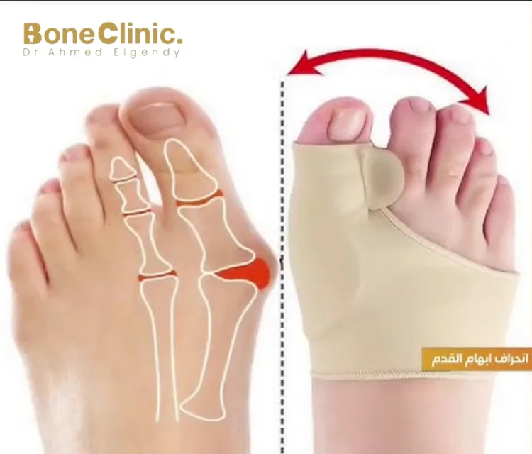كيف يمكن علاج بروز عظمة القدم بدون جراحة؟