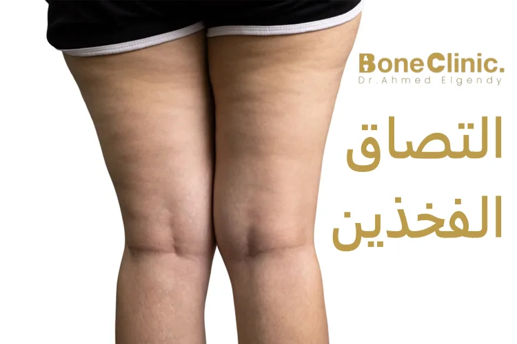 ما هو التصاق الفخذين​؟