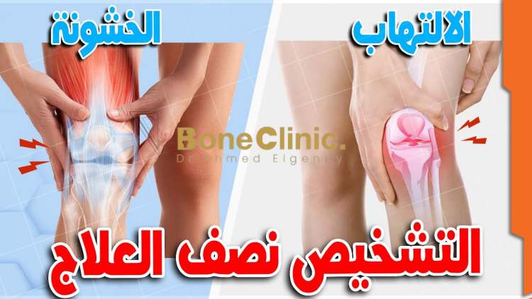 ما الفرق بين التهاب مفصل الركبة وخشونة الركبة؟