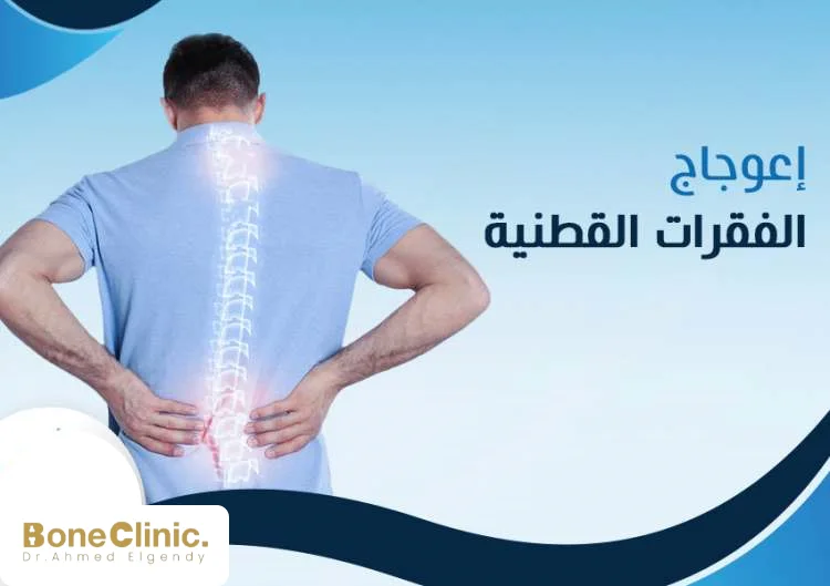 ما هو اعوجاج الفقرات القطنية؟