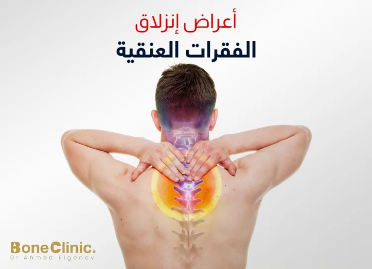 ما هي أعراض التهاب الفقرات العنقية؟