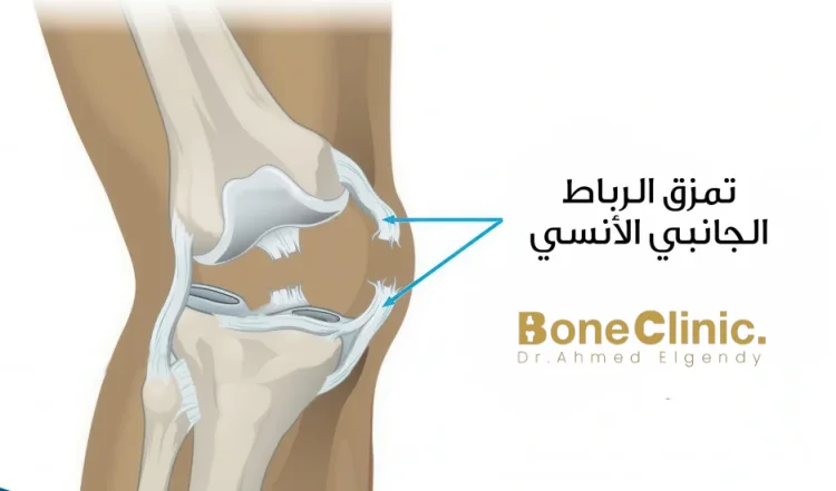 ماذا تعرف عن تمزق الرباط الجانبي الداخلي للركبة؟