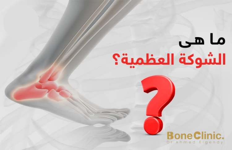 ما هى الشوكة العظمية​