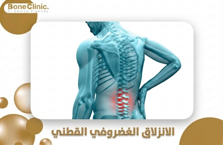 الانزلاق الغضروفي القطني