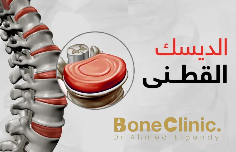 ما هو الانزلاق الغضروفي القطني (الديسك)؟