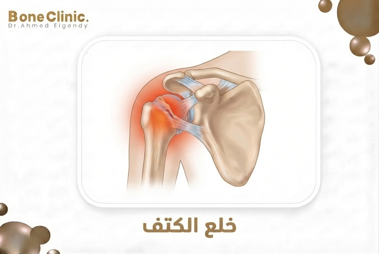 خلع الكتف