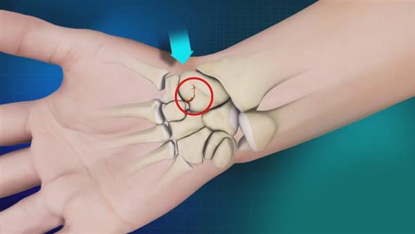 تكلفة عملية العظمة الزورقية تكلفة عملية العظمة الزورقية
